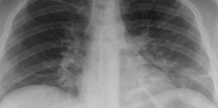 Una nueva tecnología redujo un 85% una causa frecuente de muerte en los hospitales
